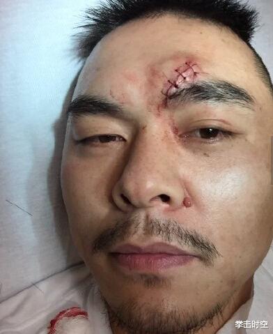 中国重量级拳王被美国三流拳手打成重伤，目前已出现肾衰竭(9)